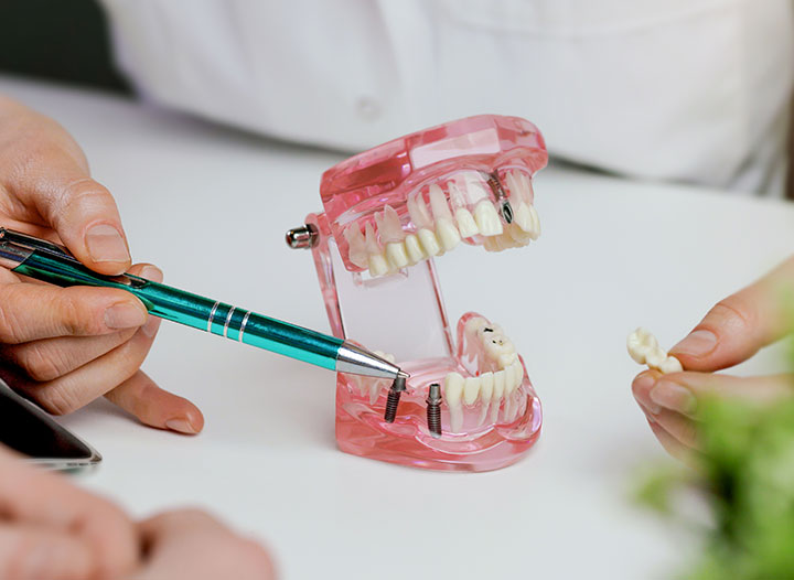 implant